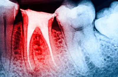 Root canal therapy (Endodontic treatment or surgery)