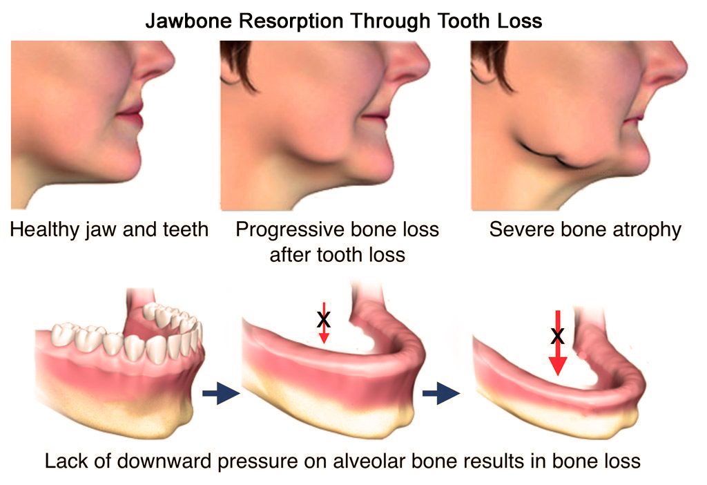 Jawbone resorption through tooth loss