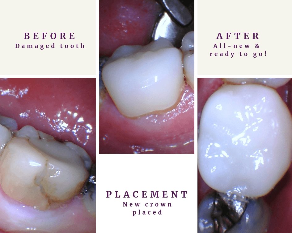 CEREC Dental Crown Before and After