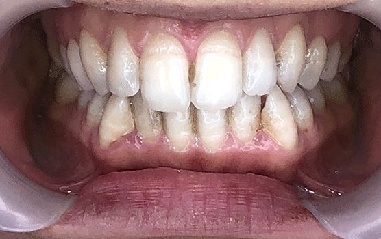Failed-Teeth-whitening-with-damaged-enamel