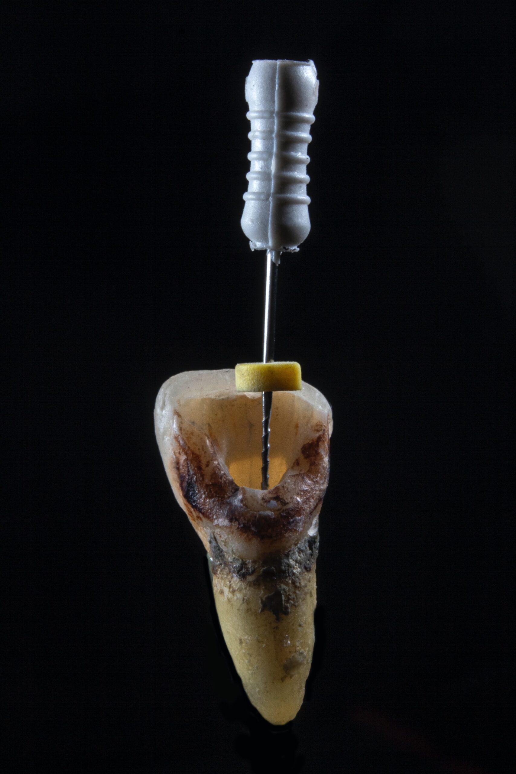image showing how root canal therapy works